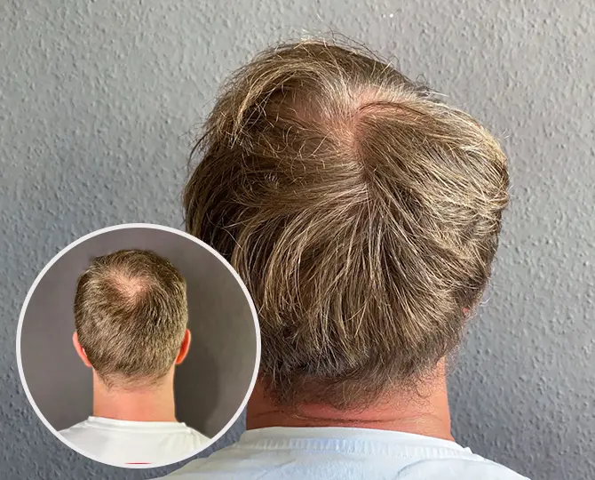 PRP Ergebnis Patient 1