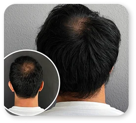 PRP Ergebnis Patient 11