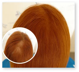 PRP Ergebnis Patient 12