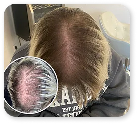 PRP Ergebnis Patient 2