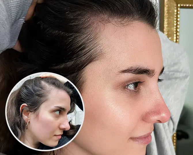 PRP Ergebnis Patient 3