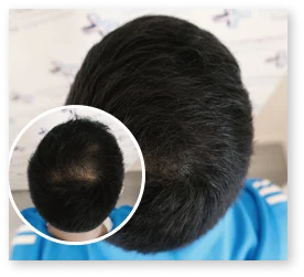 PRP Ergebnis Patient 6