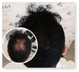 PRP Ergebnis Patient 8